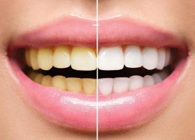 آیا جرم گیری برای دندان مضر است؟