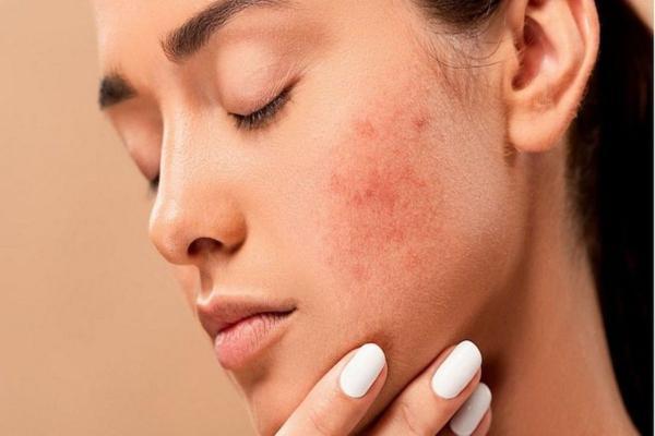7 راه حل برای درمان جوش گرمازدگی
